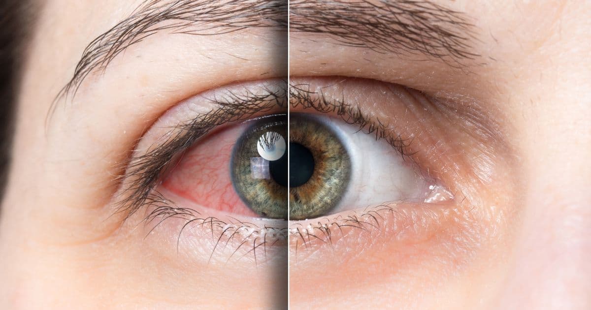 Occhi rossi o secchi: Sintomi e l’effetto delle lacrime artificiali