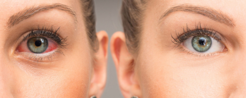 Collirio lubrificante secchezza oculare